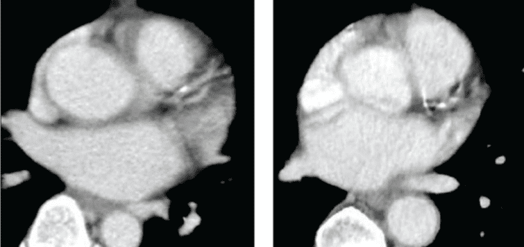 CT CAC Scans